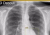 Sanità del futuro: l’intelligenza artificiale in aiuto ai radiologi di Pesaro e Fano. Rebonato: “Ma l’uomo resta al centro”