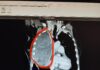 Pesaro. Asportato sarcoma di 24 cm dal torace di una donna